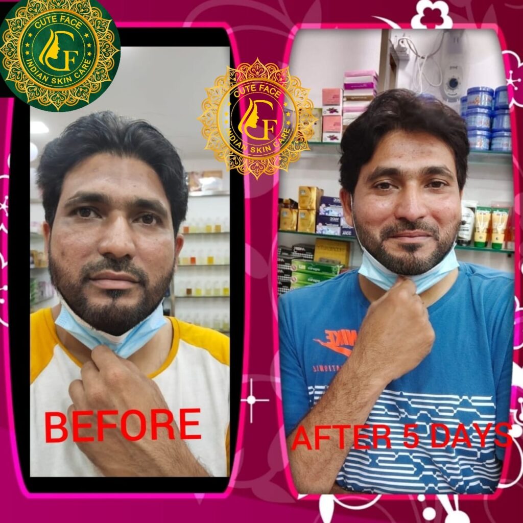 Skincare Results
