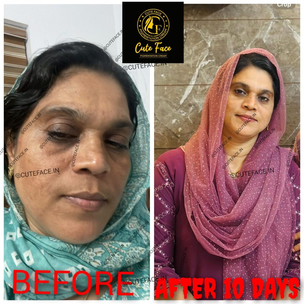 Skincare Results