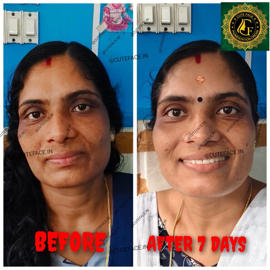Skincare Results