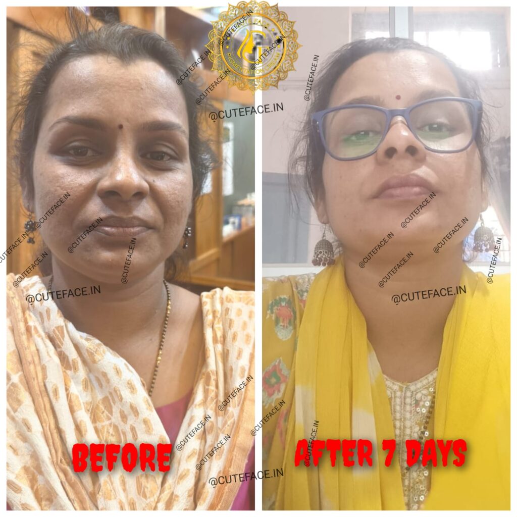 Skincare Results