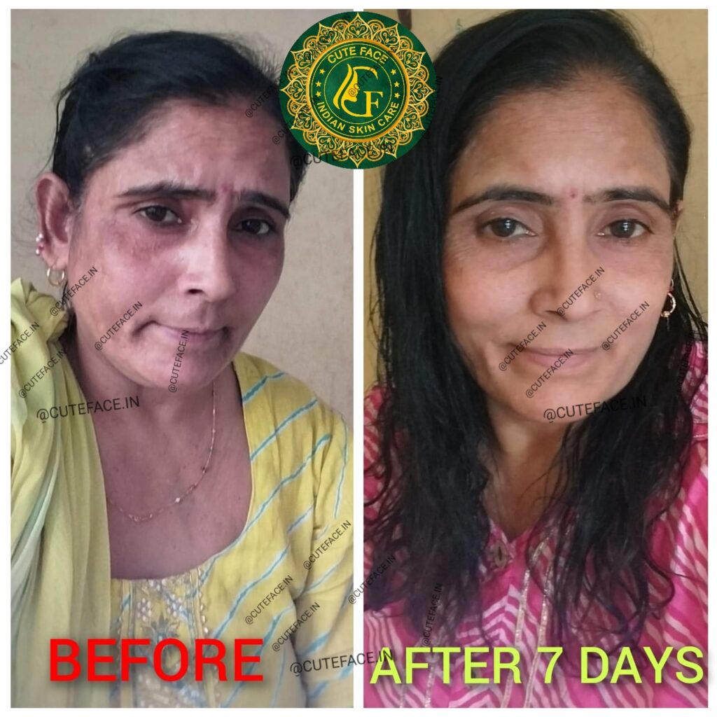 Skincare Results